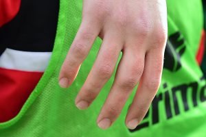 Die Hand von Keeper Grubba. Deutlich zu sehen: der lädierte Mittelfinger. Foto: KBS-Picture